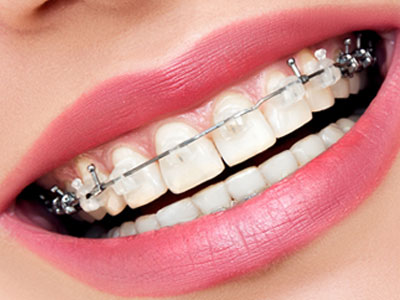 Self-litigating braces