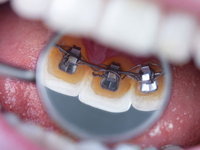 Lingual braces hide behind the teeth