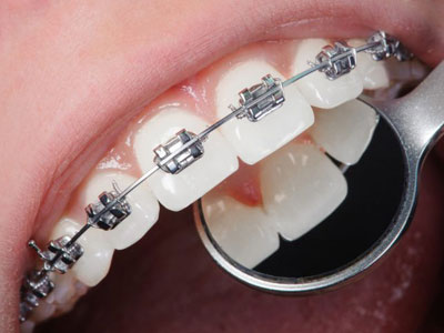 Helpful tips for maintaining your braces.