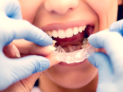 clear aligners for teeth