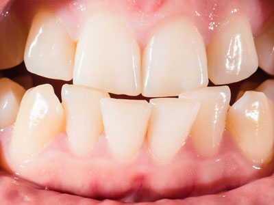 Malocclusion, misaligned teeth