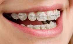 clear Braces Vancouver BC CLEAR (CERAMIC) BRACES