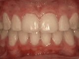crowding-of-the-teeth-after