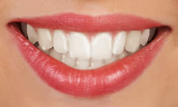 invisalign Vancouver CLEAR ALIGNERS
