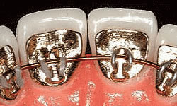 lingual Braces Vancouver LINGUAL BRACES