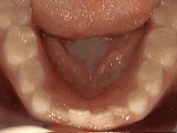 non-braces-treatment-before
