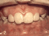 overbite-before