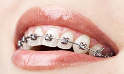 self-ligating-braces Vancouver SELF-LIGATING BRACES