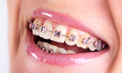 traditional-metal Braces in Burnaby TRADITIONAL METAL BRACES