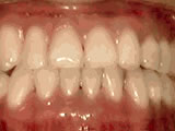 underbite-after
