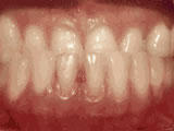 underbite-before