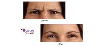 botox glabella FACIAL REJUVINATION