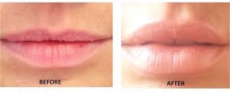 lip enhancement THE PERFECT POUT