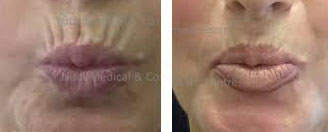 Botox Lips ERASE LIP LINES