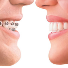 Metal brackets vs Invisalign