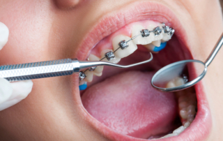 Dental Check Up on Teeth with Braces
