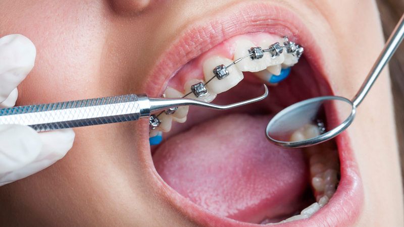 Dental Check Up on Teeth with Braces