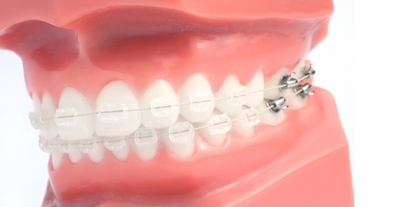 Braces