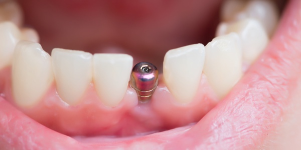 Implants