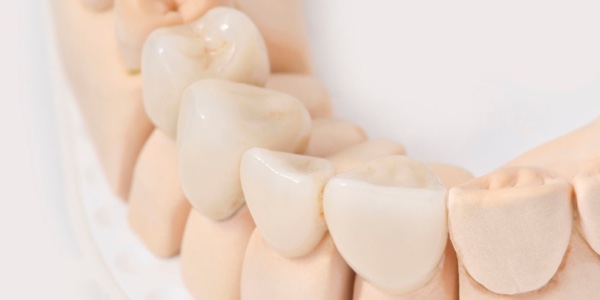 Veneers