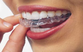 Invisalign Aligners