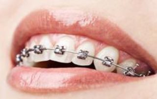 Aligners