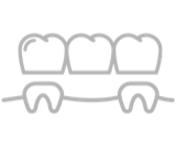 Dental bridges Dental bridges